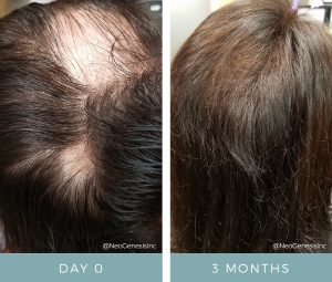 Alopecia/Hairloss Treatments
