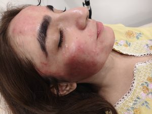 Expert Psoriasis Treatment by Dr. Sommiya Anum | Skin Guide