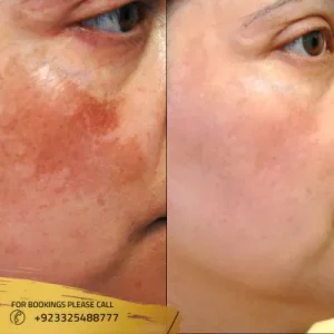 What Is Eczema and Dermatitis?
