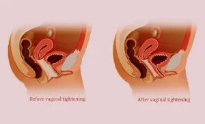 Vaginal-Tightening