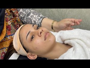 : best-melasma-treatment-lahore