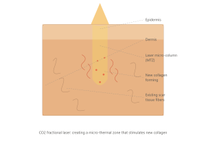 Acne Scar Treatment with CO2 Fractional Laser - Skin Cross Section"