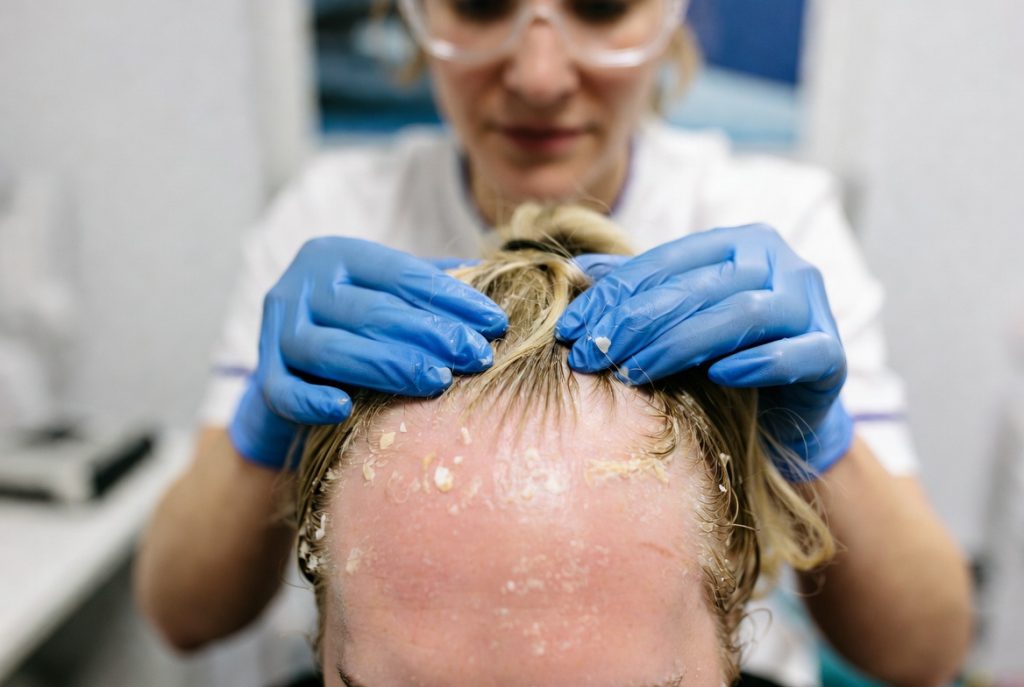 seborrheic-dermatitis-causes-genetics-hair-loss-treatment